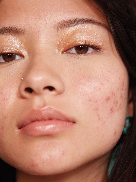 Acne & Blemishes