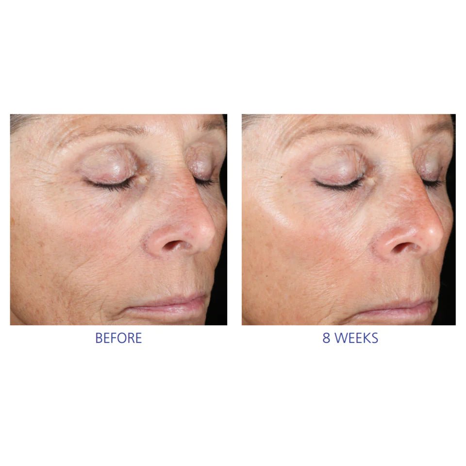 ACTIVE PEEL SYSTEM - Beauty Matters
