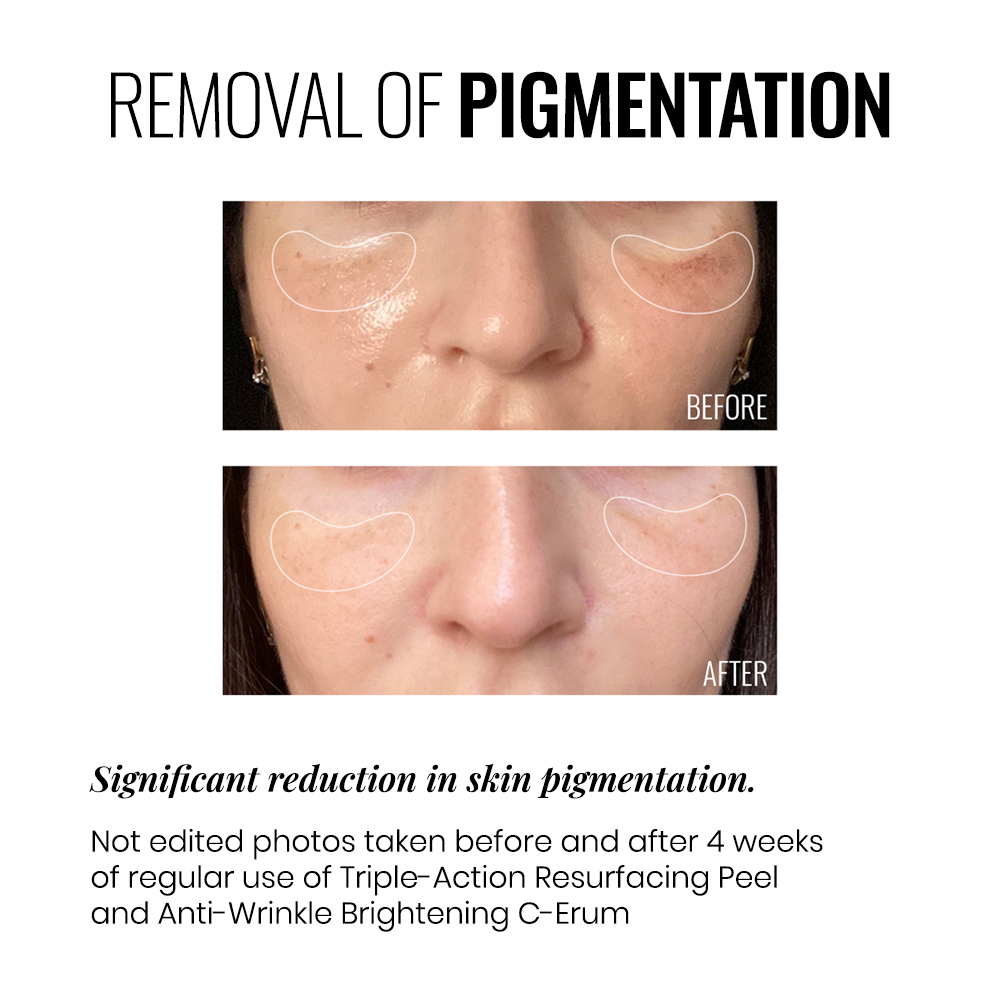 TRIPLE-ACTION RESURFACING PEEL | Beauty Matters